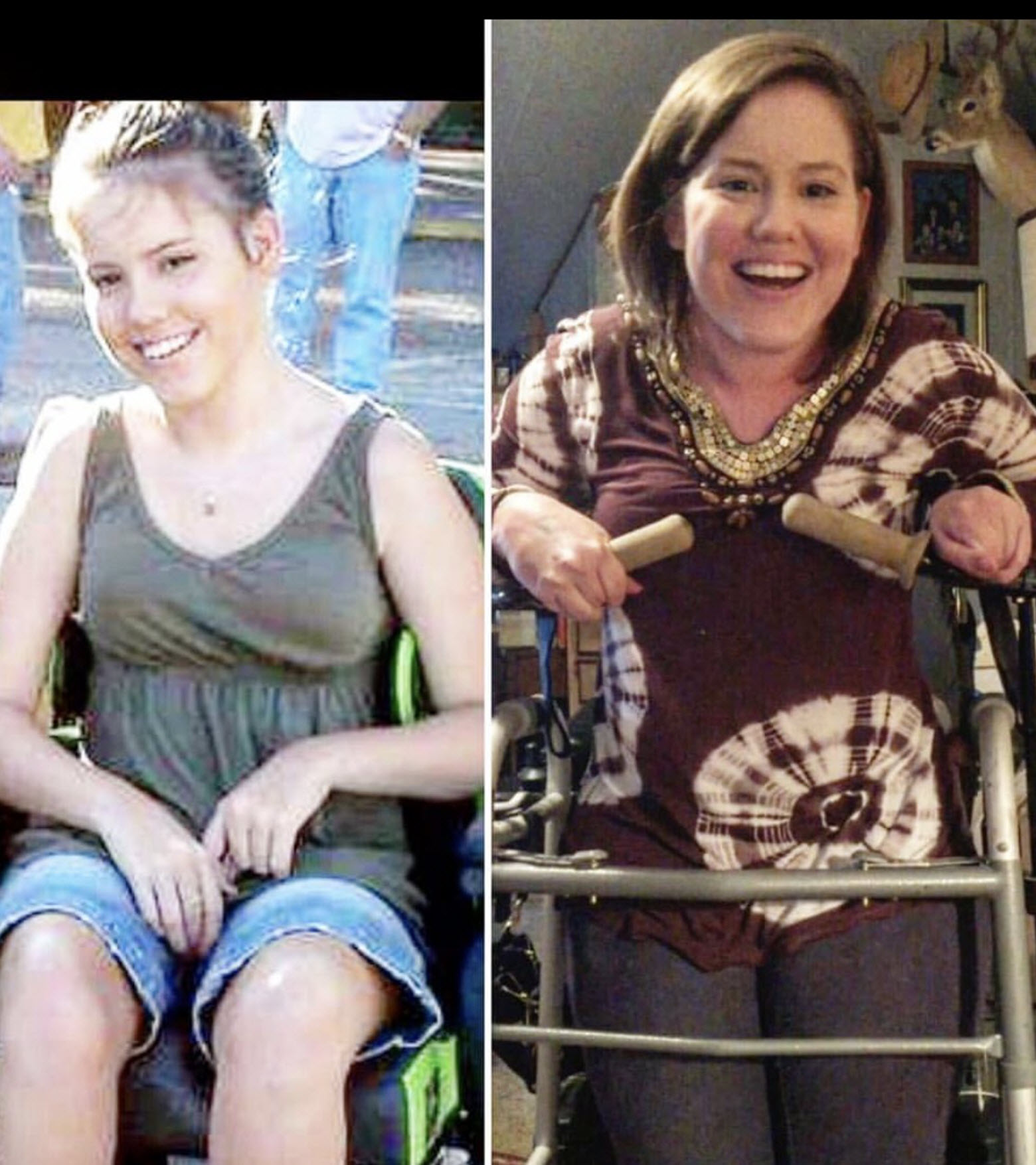two photos of a woman with cerebral palsy -one in a wheelchair and a the other using a walker