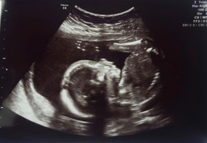 ultrasound of baby